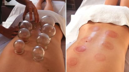 why olympians have big red circles all over the skin