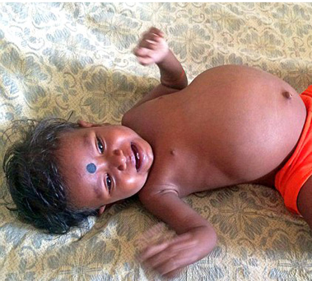 parasitic twin was growing inside girl