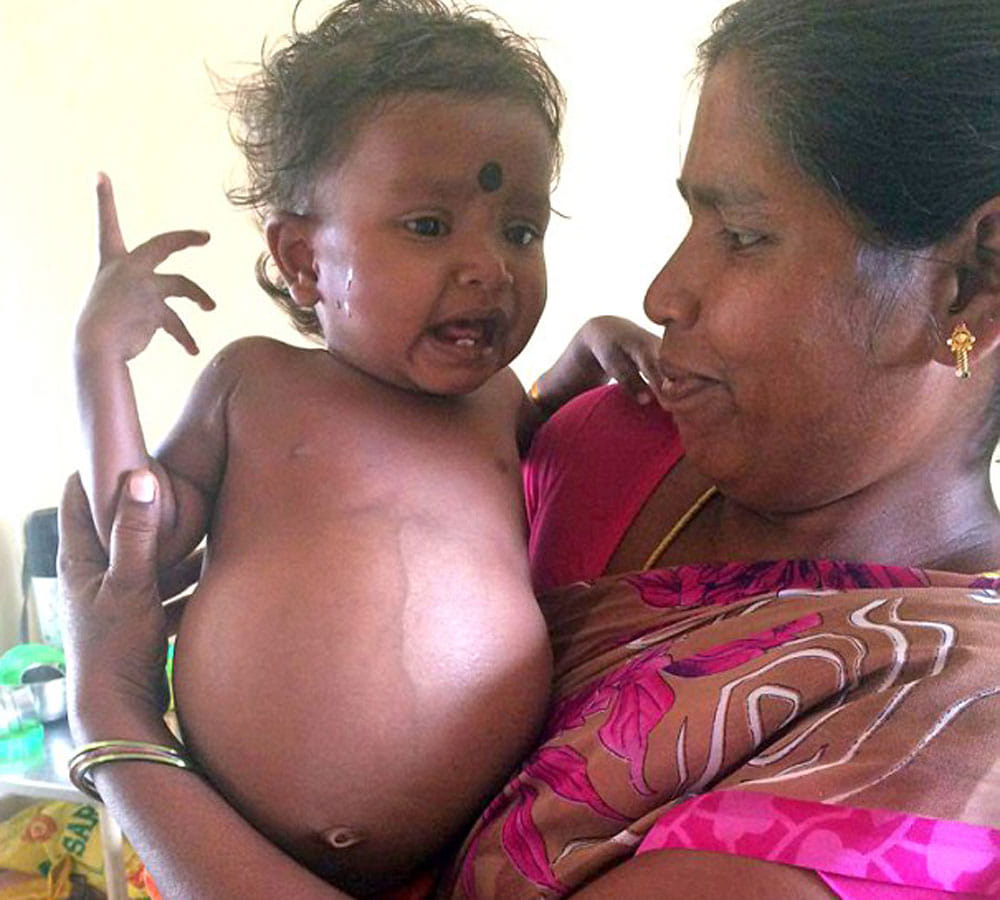 parasitic twin was growing inside girl