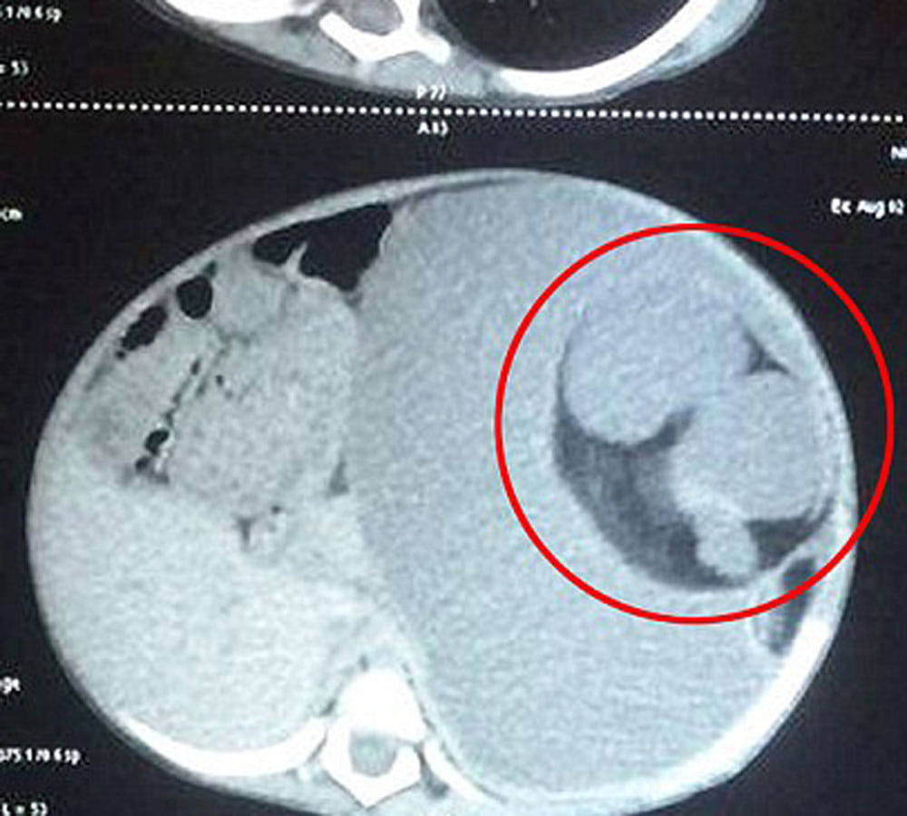 parasitic twin was growing inside girl