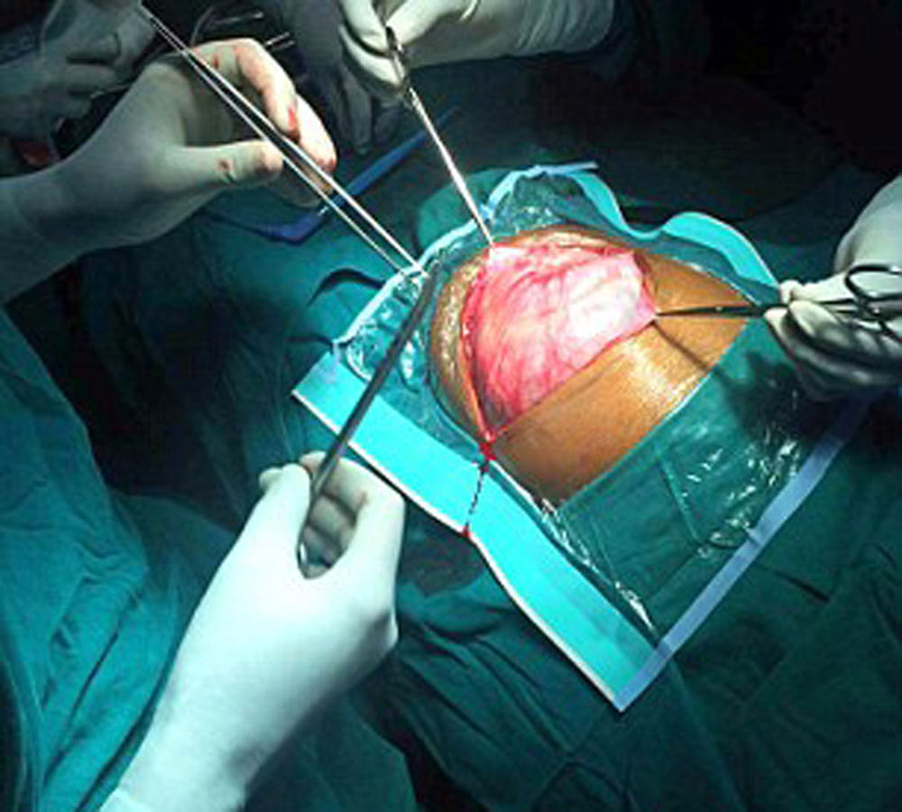 parasitic twin was growing inside girl