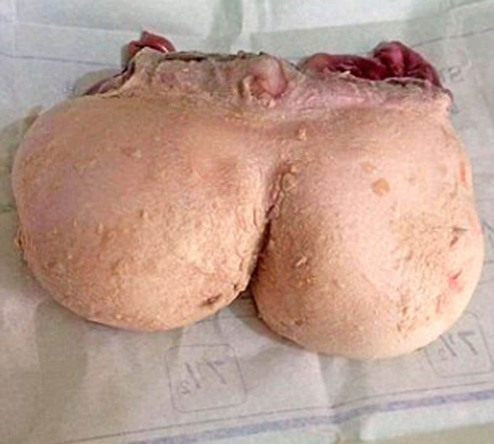 parasitic twin was growing inside girl