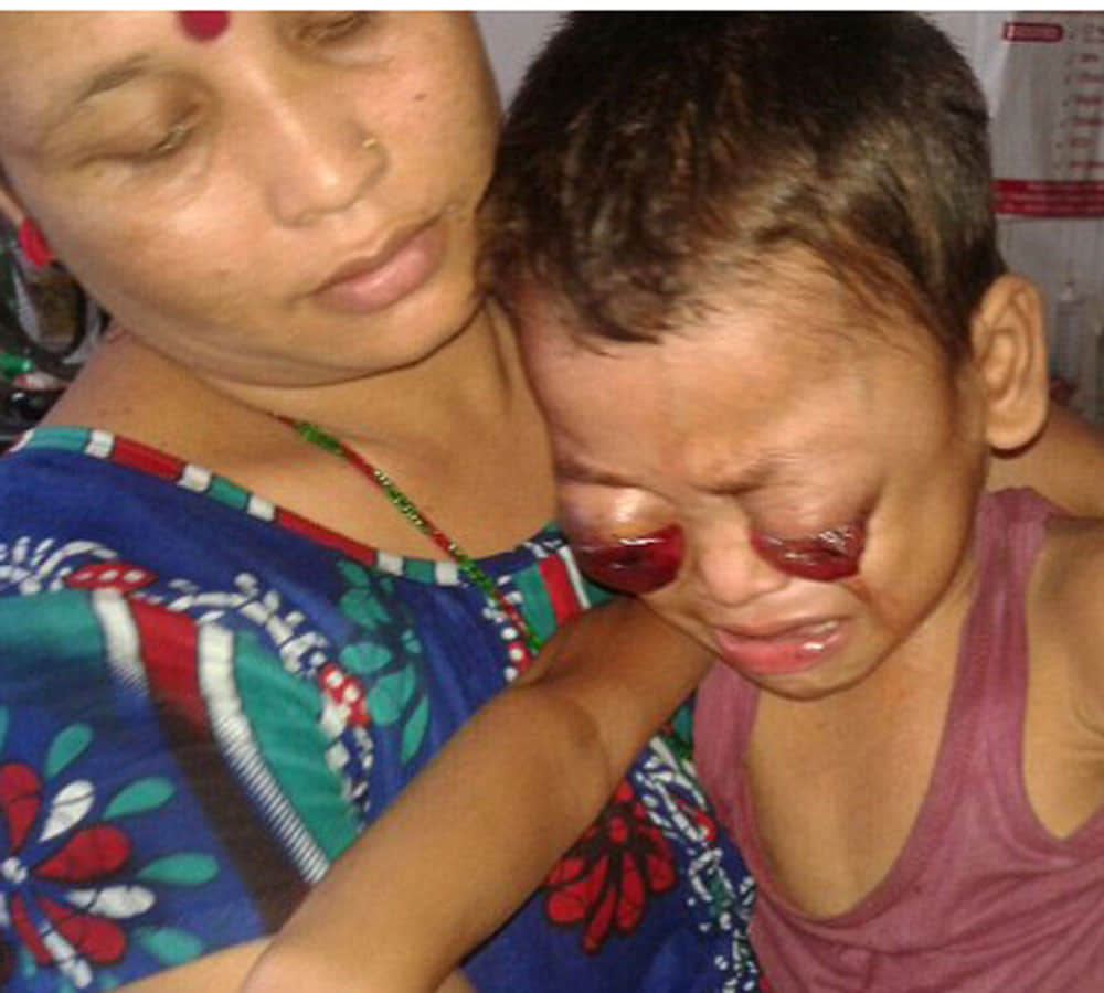 little boy eyes bleed and pop out doctors baffled