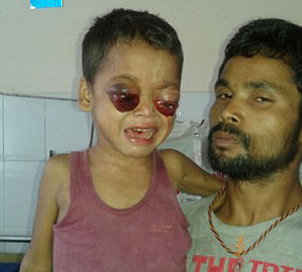 little boy eyes bleed and pop out doctors baffled