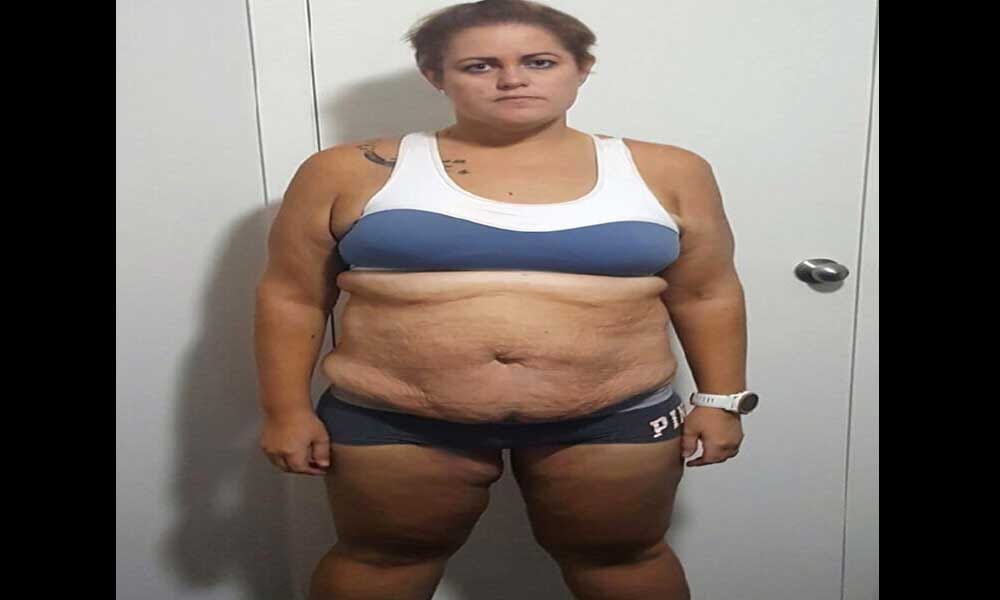 Woman Become Balloon Due To Eating Burgers