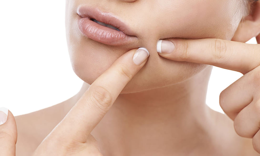 tips to cure acne 