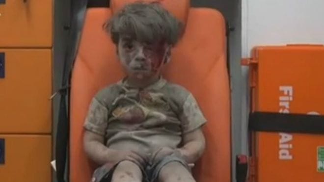 Syria wounded child photo Viral  