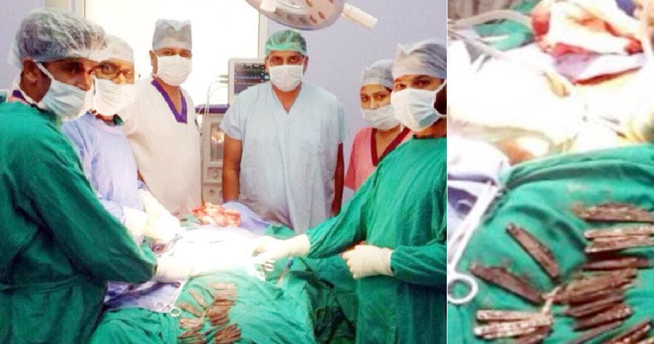 unique people, gurdaspur man swallowed 40 knife with water, doctors found it during operation
