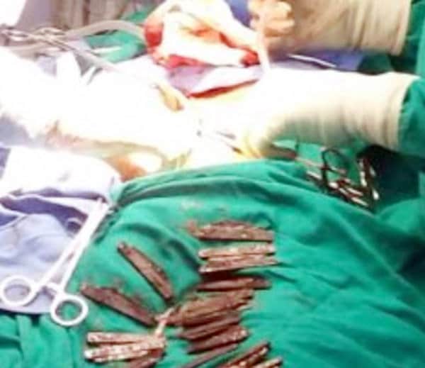 boy swallow 40 knife in gurdaspur of punjab, weird people, ajab gajab people, unique people