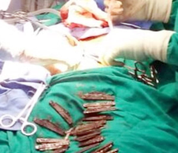 unique people, gurdaspur man swallowed 40 knife with water, doctors found it during operation