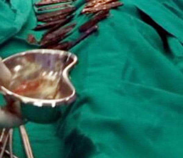 unique people, gurdaspur man swallowed 40 knife with water, doctors found it during operation
