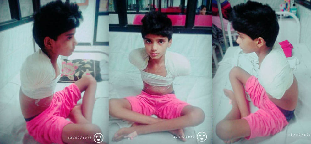 hi tension current, 3 operation and looses both hand then also tied rakhi to brother with legs