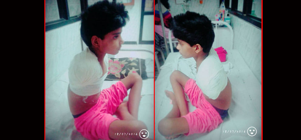 hi tension current, 3 operation and looses both hand then also tied rakhi to brother with legs