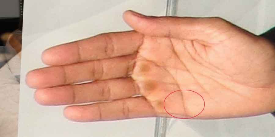 palmistry sign of impotency 