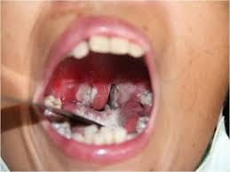 diphtheria apprehensive child deaths in Bilari