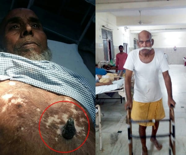 A rare case in balrampur hospital.