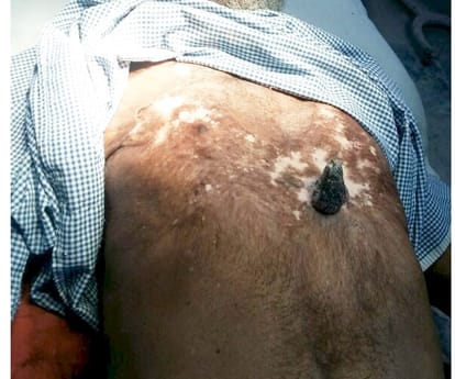 A rare case in balrampur hospital.