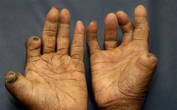 leprosy, leprosy disease, health deptt, chandigarh health deptt, health update, chandigarh