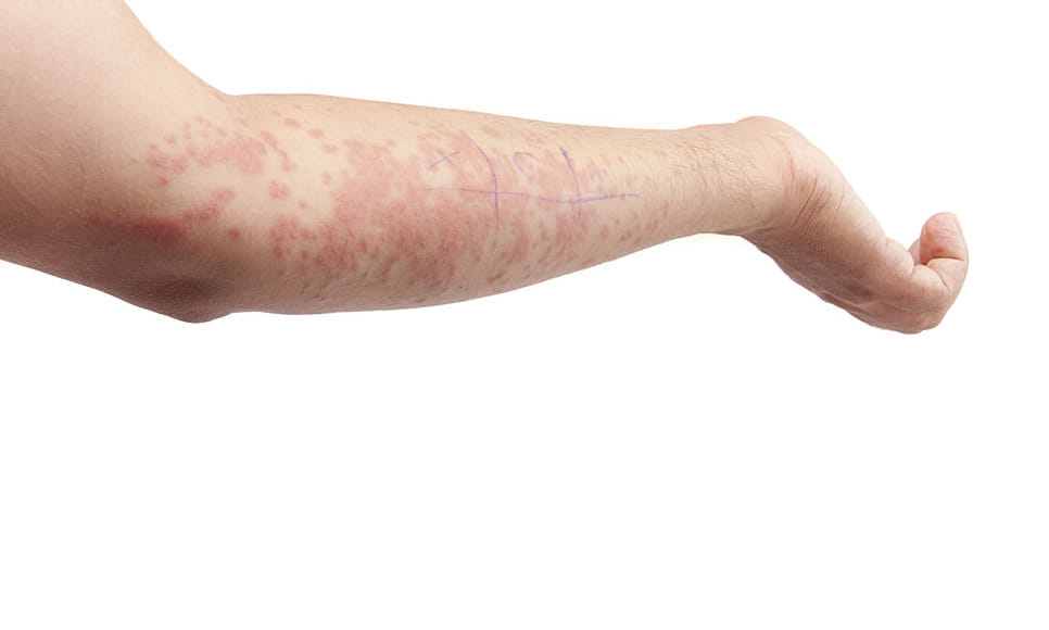 cause and treatment of chickengunia