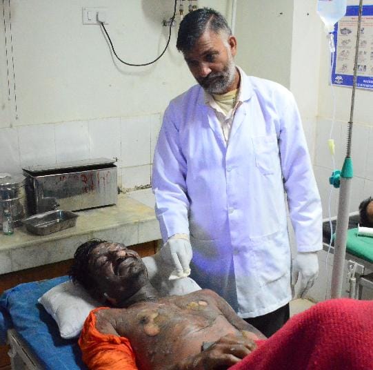 burnt in fire at Jhalera