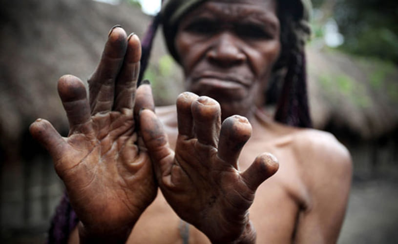 Finger Cutting Tradition in Papua