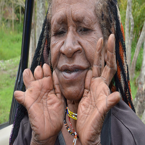 Finger Cutting Tradition in Papua