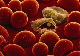 three cases of falciparum malaria in districr hospital