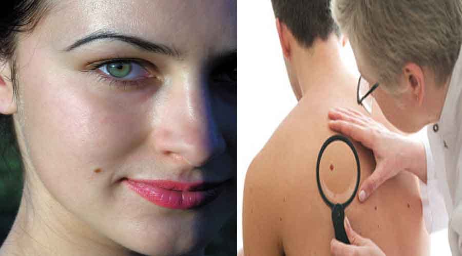 mole on these body parts are lucky