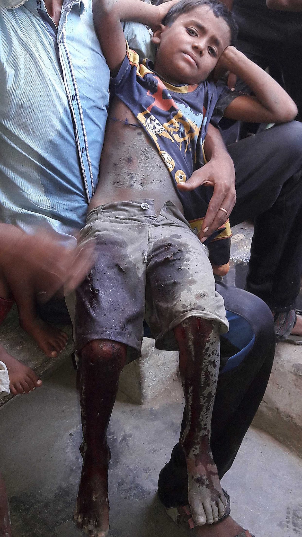 Truck tire exploded, injuring four children, Referee चार बच्चे घायल