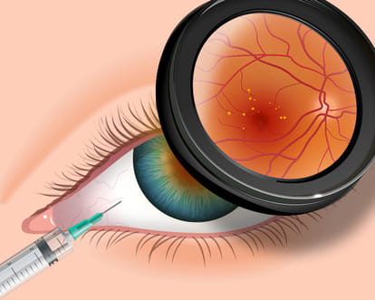 PGI's Advanced Eye Department Avestin injection is completely closed