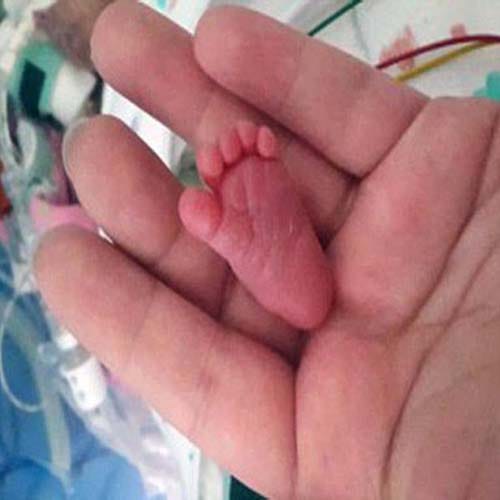 world's tiniest baby Emilia
