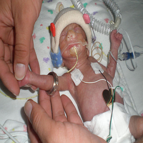 world's tiniest baby Emilia