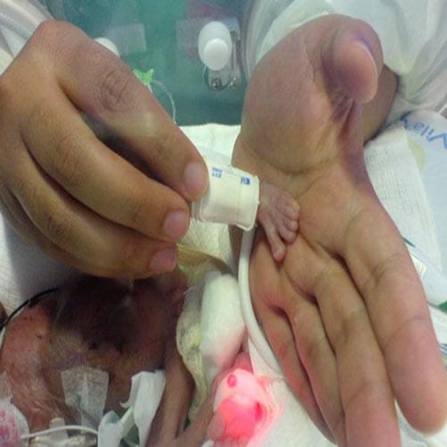 world's tiniest baby Emilia