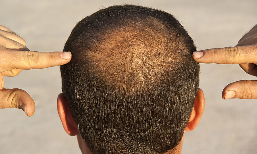 home remedies foe baldness