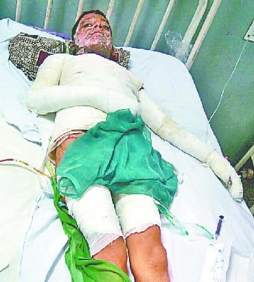 boy burned by gas stove in udhampur