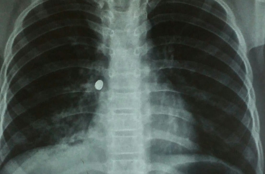 The procession of the groom before extraction condition deteriorates, death