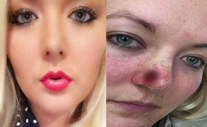 Skin Cancer Due To Tanning Beds