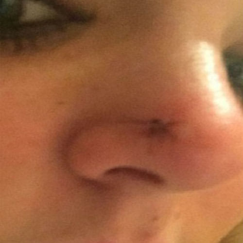 Skin Cancer Due To Tanning Beds
