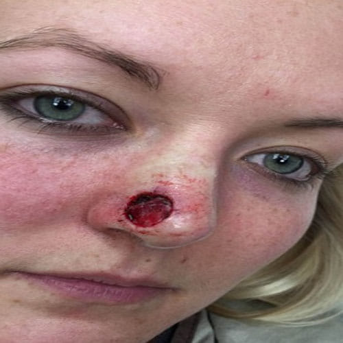 Skin Cancer Due To Tanning Beds