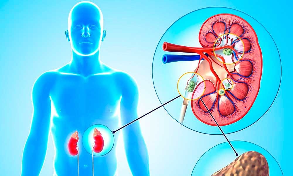 These 6 Food Items Can Cause Kidney Stone