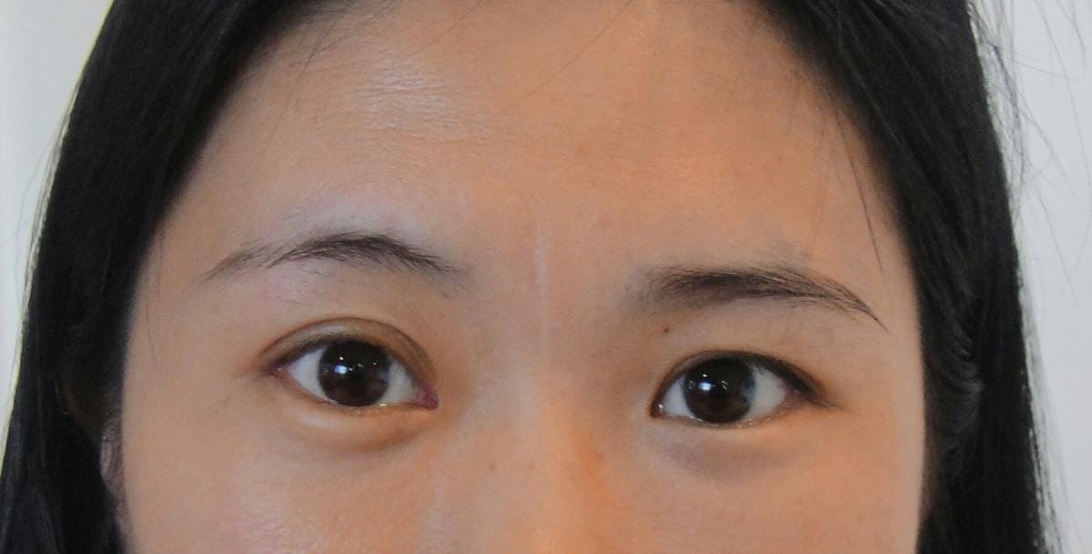 pimples on different areas of face indicates different diseases in hindi