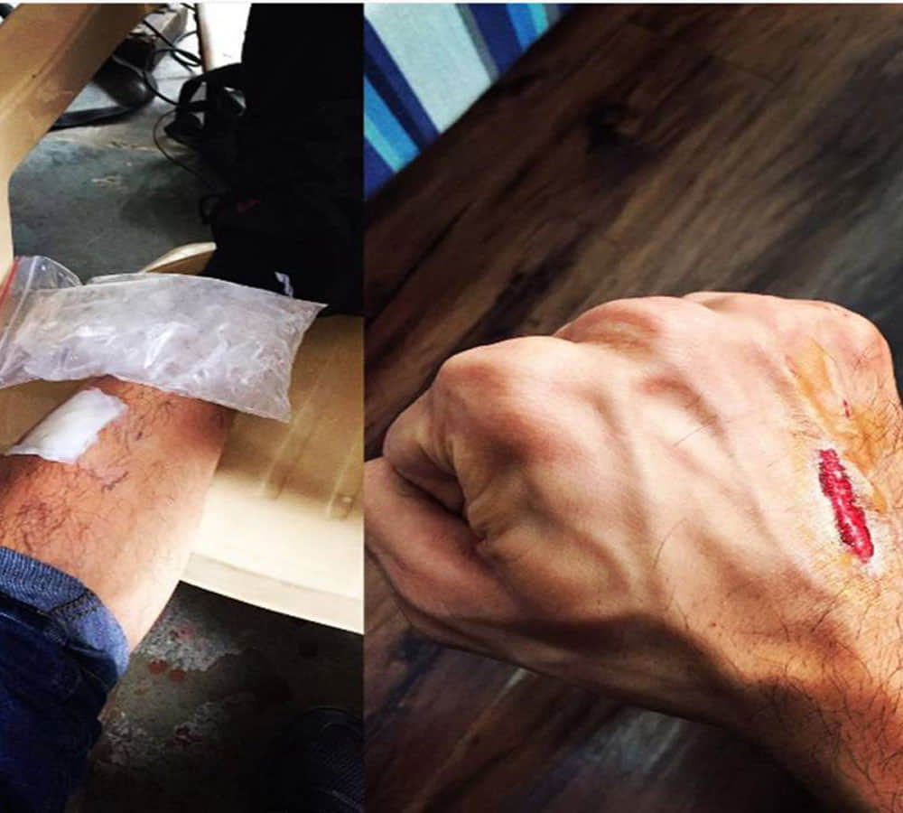 siddharth malhotra is hurt during shoot