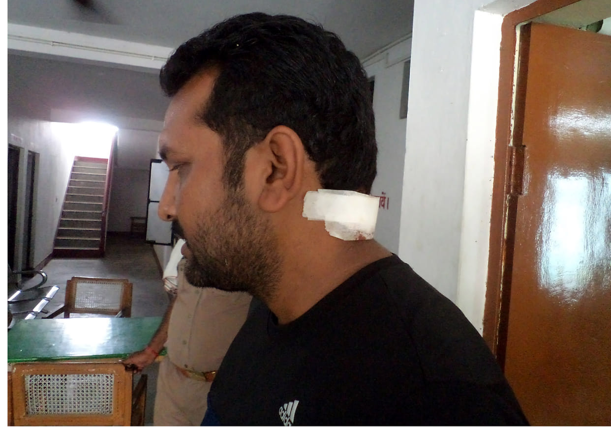 BJP leader injured in attack by monkeys