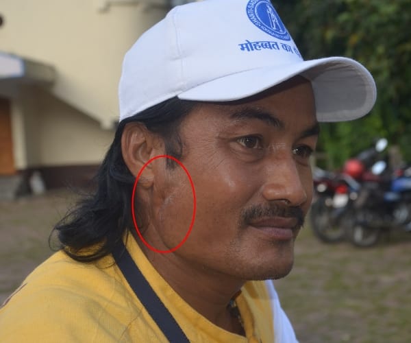  kokrajhar resident amar dutta carries terrorist bullet in his jaw