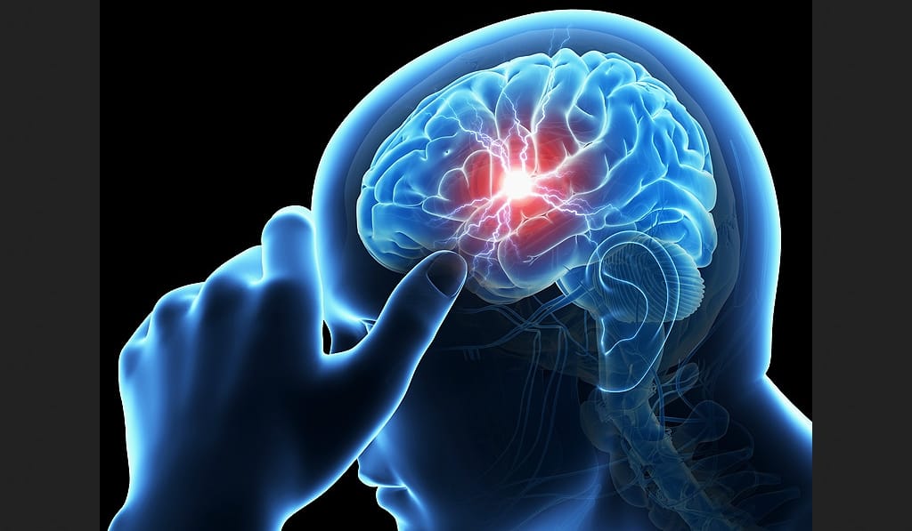 IGMC Doctors Study on Brain Stroke.