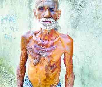 Acid thrown on the elderly at night, scorching
