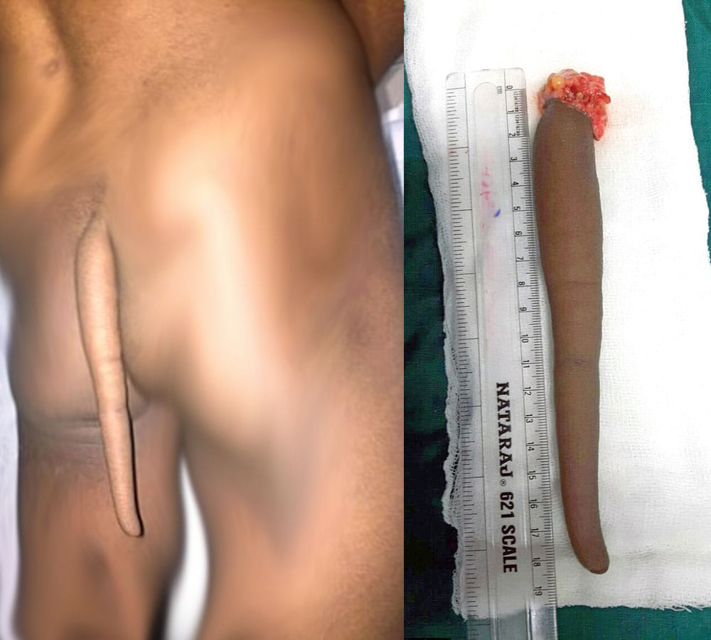 doctors removed vestigial tail from 18 years old boy back in nagpur