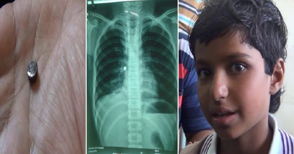 Toy battery found in child's body, operations in rohtak pgi