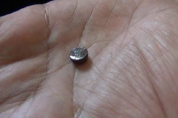Toy battery found in child's body, operations in rohtak pgi