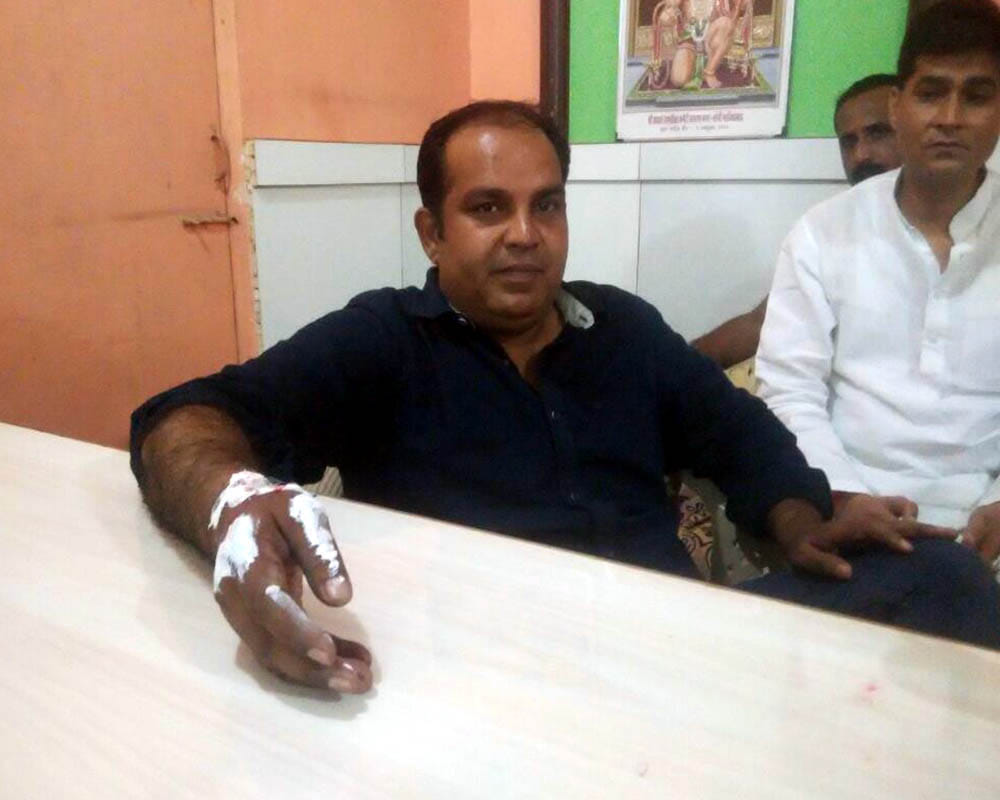 Chairman hand burned in Rahul's effigy burn